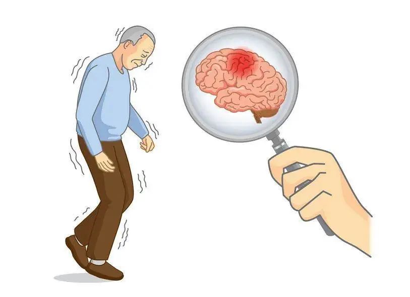 Parkinson's-Disease